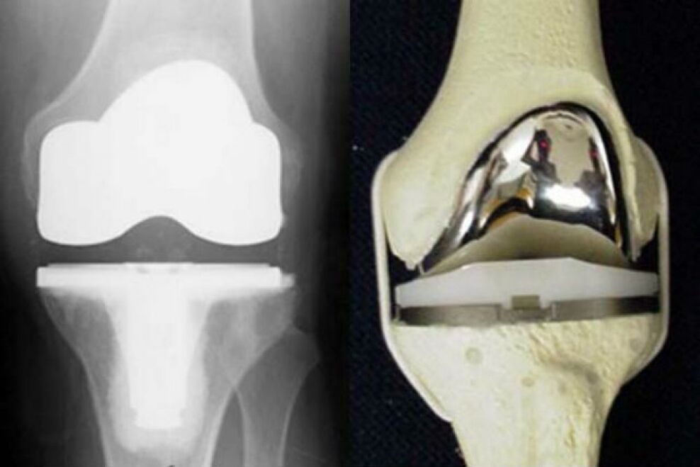 knee joint replacement for arthrosis