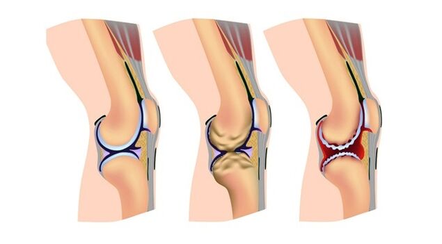 stage of knee joint arthrosis