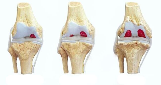 stage of knee osteoarthritis