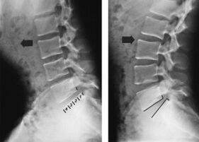 vertebral displacement in thoracic osteochondrosis