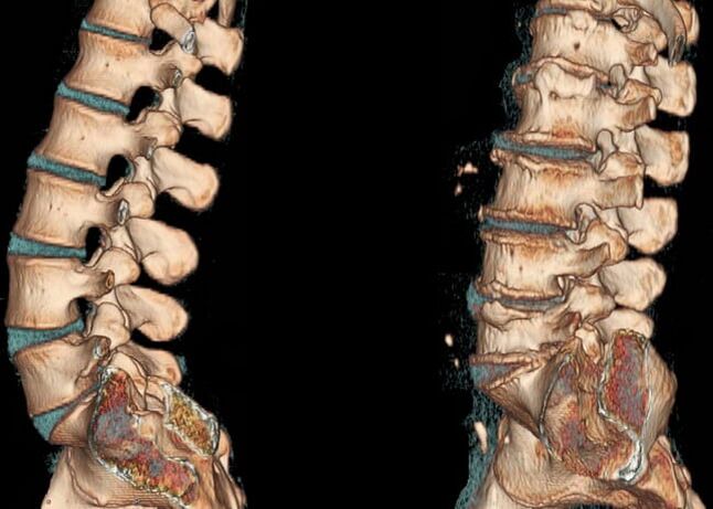 Osteochondrosis of the lumbar area