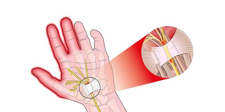 Pain in the finger joints with risartrosis