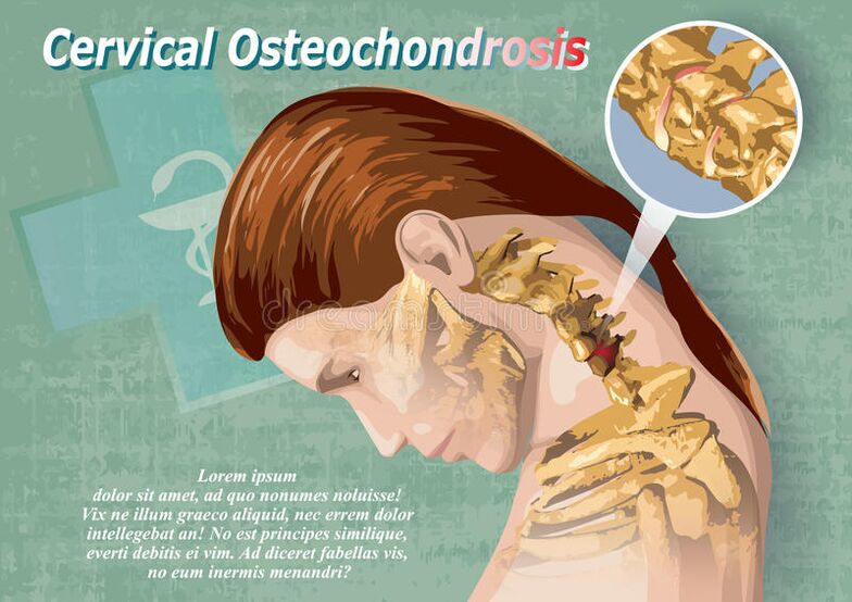 Cervical osteochondrosis is a cartilage of bone tissue