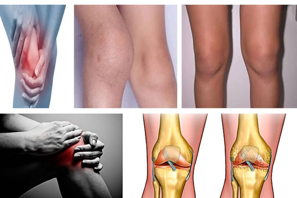 symptoms of knee arthrosis